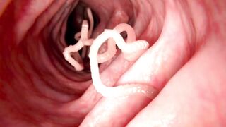 PARASITE CLEANSE: DIY Protocol and Home Remedy