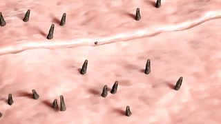 What Is An Ingrown Hair? ????