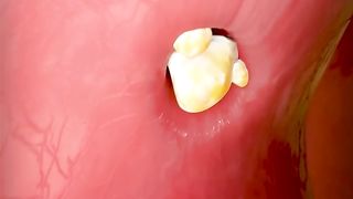 What Are Tonsil Stones? ????