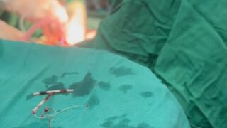 drghulamdastgeer_share_it_for_ awareness_IUCD_comlication,
