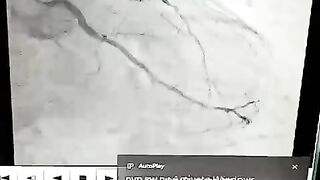 Angiography Live