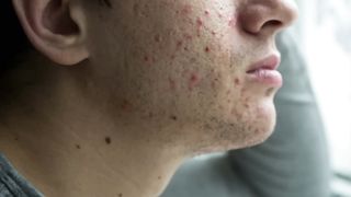 The Top Vitamin Deficiency with ACNE (Must Watch)