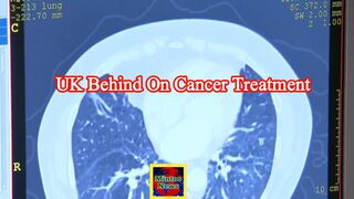 UK cancer patients suffering as nation behind in treatments, research suggests