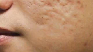 Cure for Acne