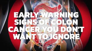 The Early Signs of Colon Cancer You DON'T Want to Ignore