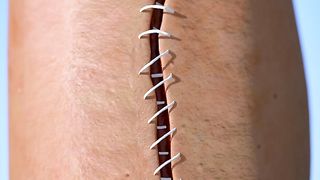 how stitches work