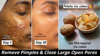 How to remove Pimples & Close Large OPEN PORES,Rub Potato Ice cubes and Niacinamide Serum, Dark Spots