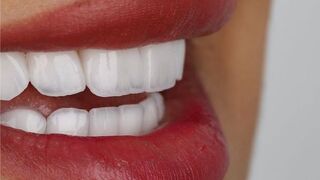 Hollywood Smile - Veneers - Zircon - Emax