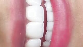 Best Veneers Hollywood Smile ابتسامة المشاهير