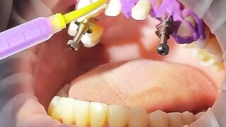 Open Tray Impression with Panasil X-Light and Tray Soft Heavy (@kettenbachusa) #dentist #impression.