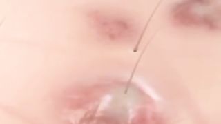 How Pimple caused in our body e