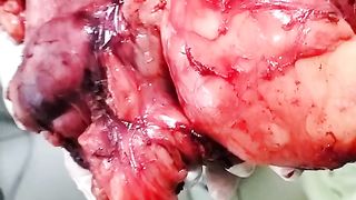Breast tumour