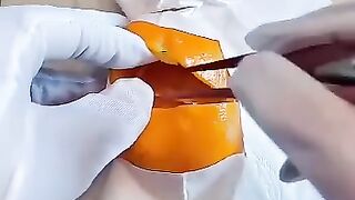 C-section