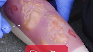 Treatment of a burn wound ???????? #ambulance #paramedic #rettungsdienst #notfall #emergency #firstaid.