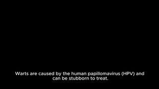 Natural treatments for warts are very important