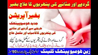 Successful treatment of kidney and bladder stones without surgery with the best homeopathic medicines