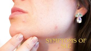 Autoimmune Disease