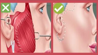 ASMR Treatment Of Cheek Lift Satisfying Surgery Animation