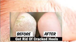 Home remedy to remove cracked  heels fast