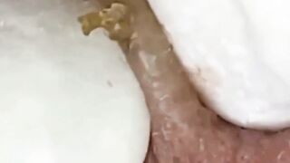 pimple popper 2