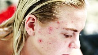 Acne treatment methods