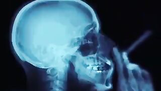 Smoke effects on MRI of a smoker.