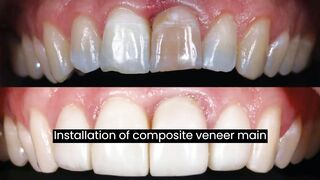 Installation of composite veneer: main features