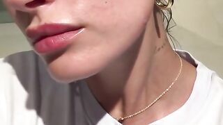 Hailey Bieber opens up about having Perioral dermatitis