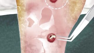 ASMR Remove worm,Plantar Warts animation