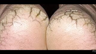 Home remedies for cracked heels
