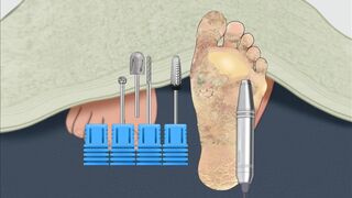 Asmr remove thick dead skin cells and callues animation