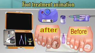Foot care at home | Treatment athlete's foot and warts between toes