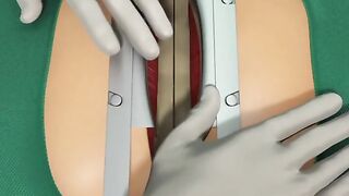 Heart Bypass Surgery 3D Animation (CABG)