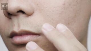 Large pores Myths | Ways to Avoid Large pores #mix #beauty #large_pores, part 1