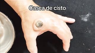 Hand wounds video