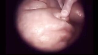 This is how We 'live' inside Womb.  Fetoscopy Procedure... Real video of Unborn Baby in Womb.