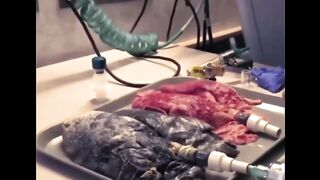 Health lung vs smoker lung