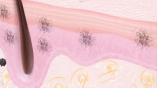 Blackheads | Causes of clogged pores #mix #blackheads_cause