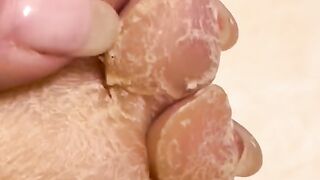 Kulit kaki terkelupas