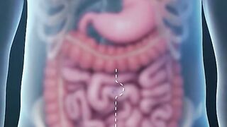 Rectum Removal Surgery 3D Animation