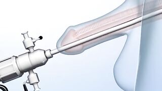 Enlarged Prostate Gland Surgery 3D Animation (Transurethral resection)