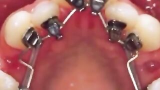 How hidden braces work
