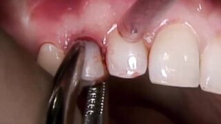 The Latest in Implant Technology