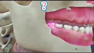 "Wisdom Teeth Removal: Before and After"