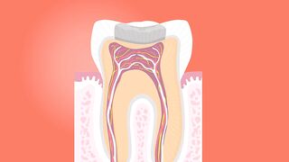 Root canal treatment