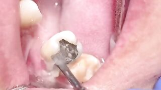 Ultrasonic Tartar Removal: A Game-Changer in Dental Hygiene"