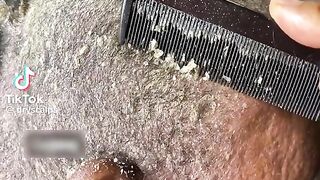 Dry scalp