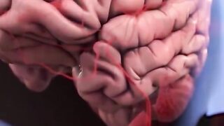 Brain Blood Clot Removal Technique 3D Animation