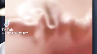 Varicose vein treatment
