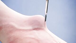 Removing_Ganglion_Cysts_